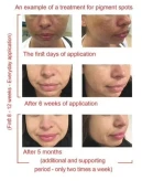 خرید کرم ضد لک قوی سیستیامین امریکا تاریخ جدید Cyspersa Liposomal Cysteamine